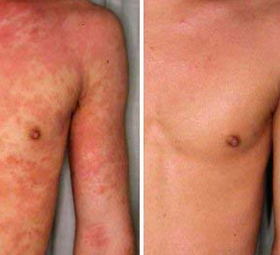 best eczema treatment in McBorough