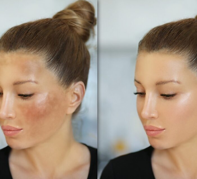 best Hyperpigmentation treatment in McBorough