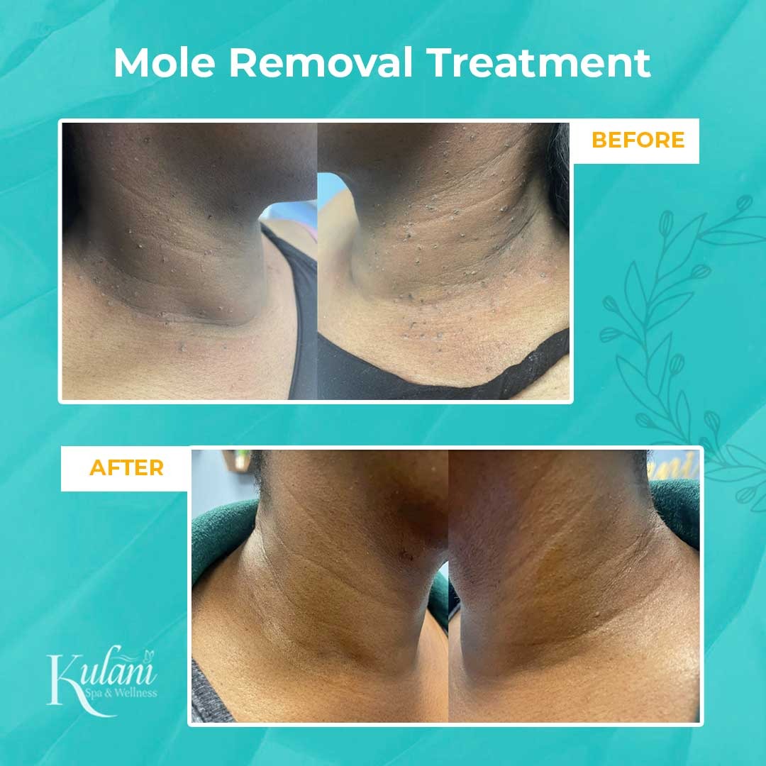best mole removal in McBorough