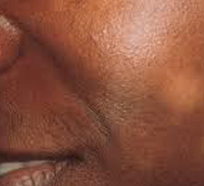 best Tinea treatment in McBorough